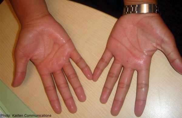 手汗を止めるための7つの方法